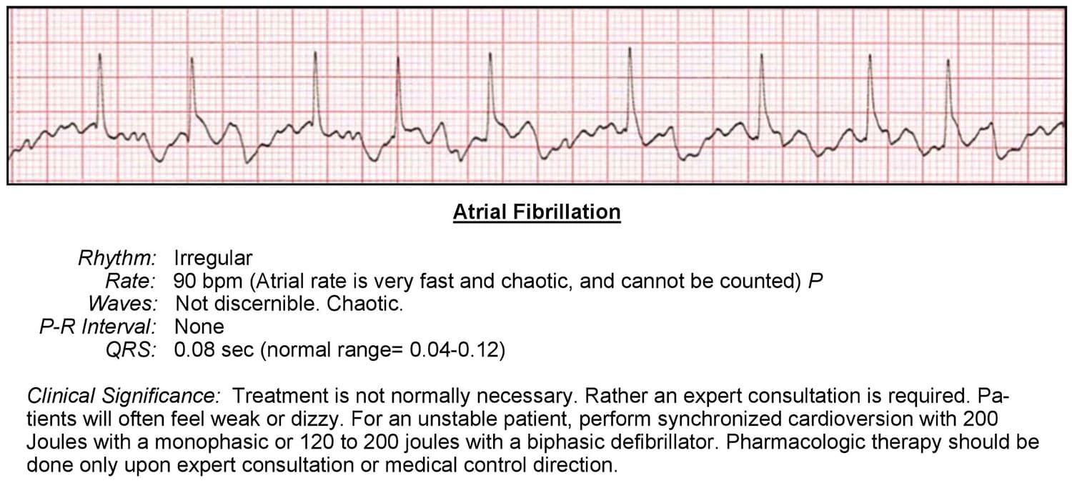 Atrial Fibrillation ECG