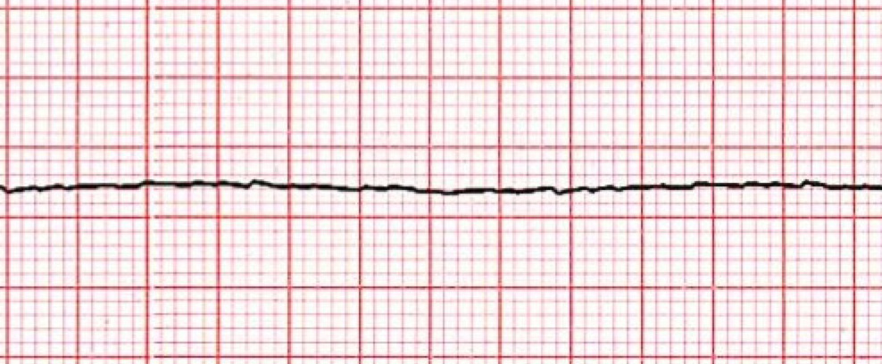 Asystole ECG