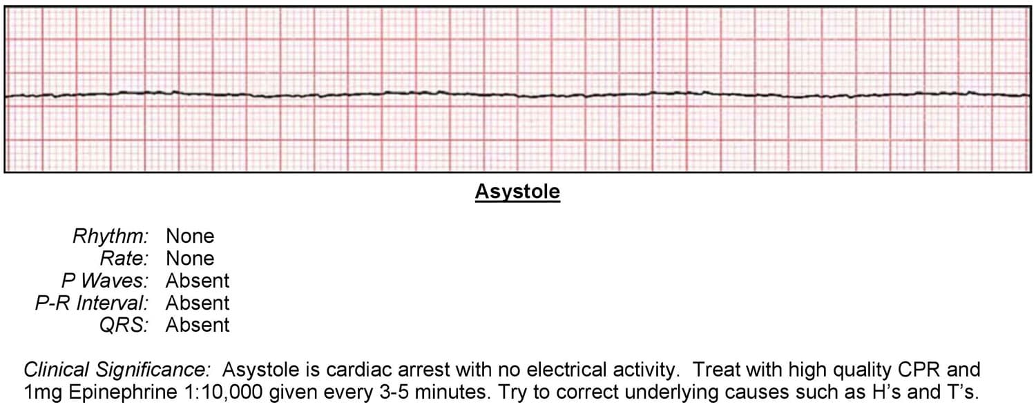 Asystole Algorithm Acls Wiki