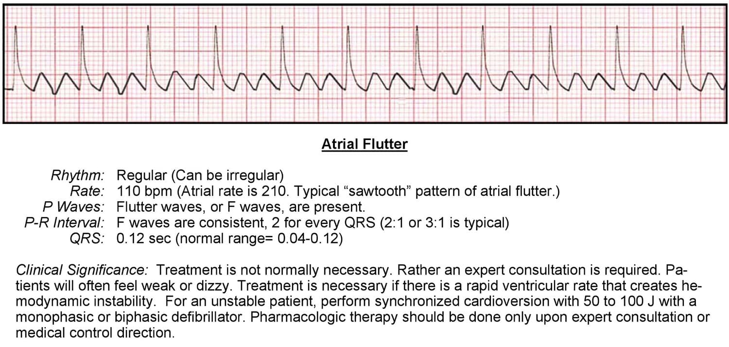 Atrial Flutter ECG
