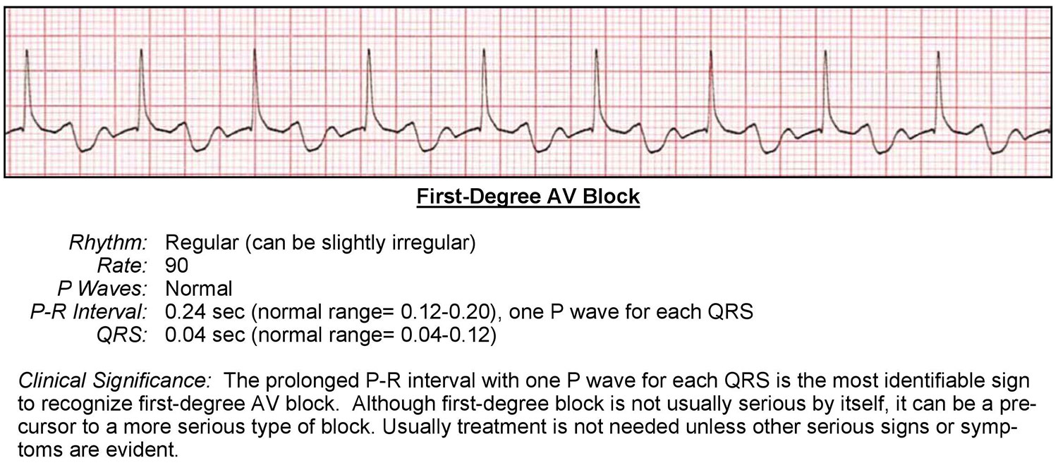 First Degree AV Block ECG