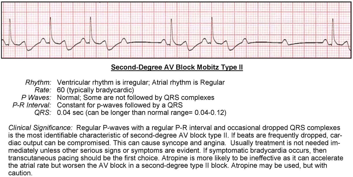 Second Degree AV Block Mobitz Type II