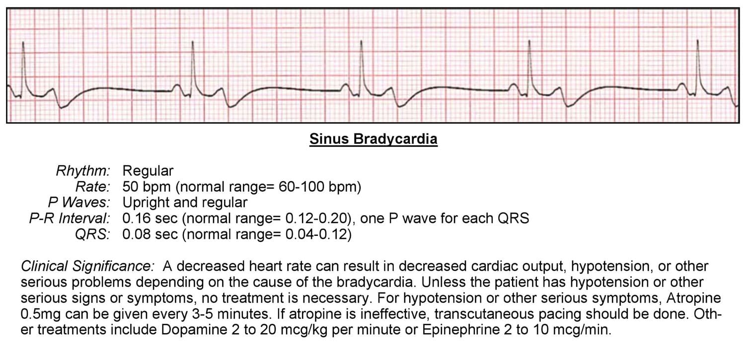 Bradycardia ECG