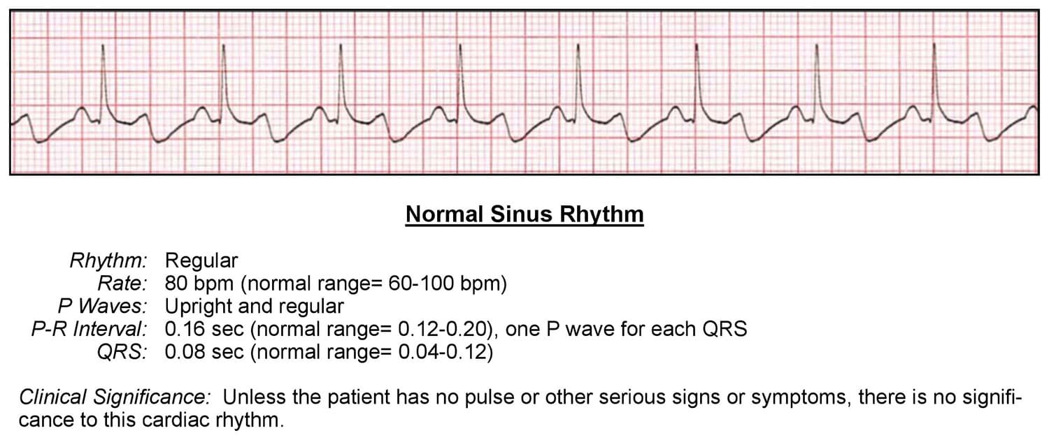 Normal Sinus Rhythm ECG