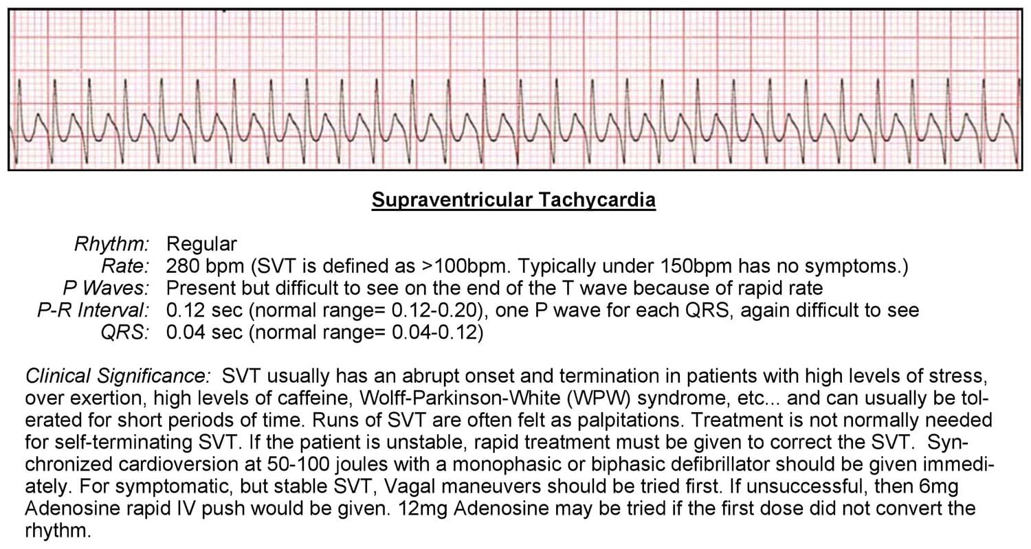 Supraventricular Tachycardia ECG