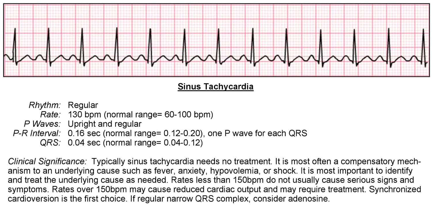 Tachycardia ECG