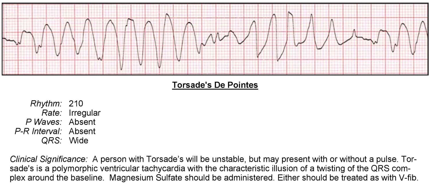 Torsade's De Pointes ECG