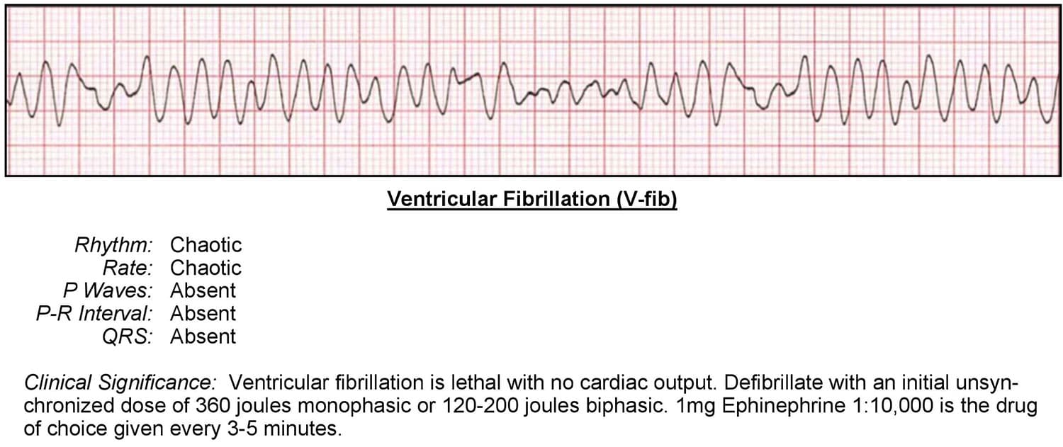 Ventricular Fibrillation ECG. 