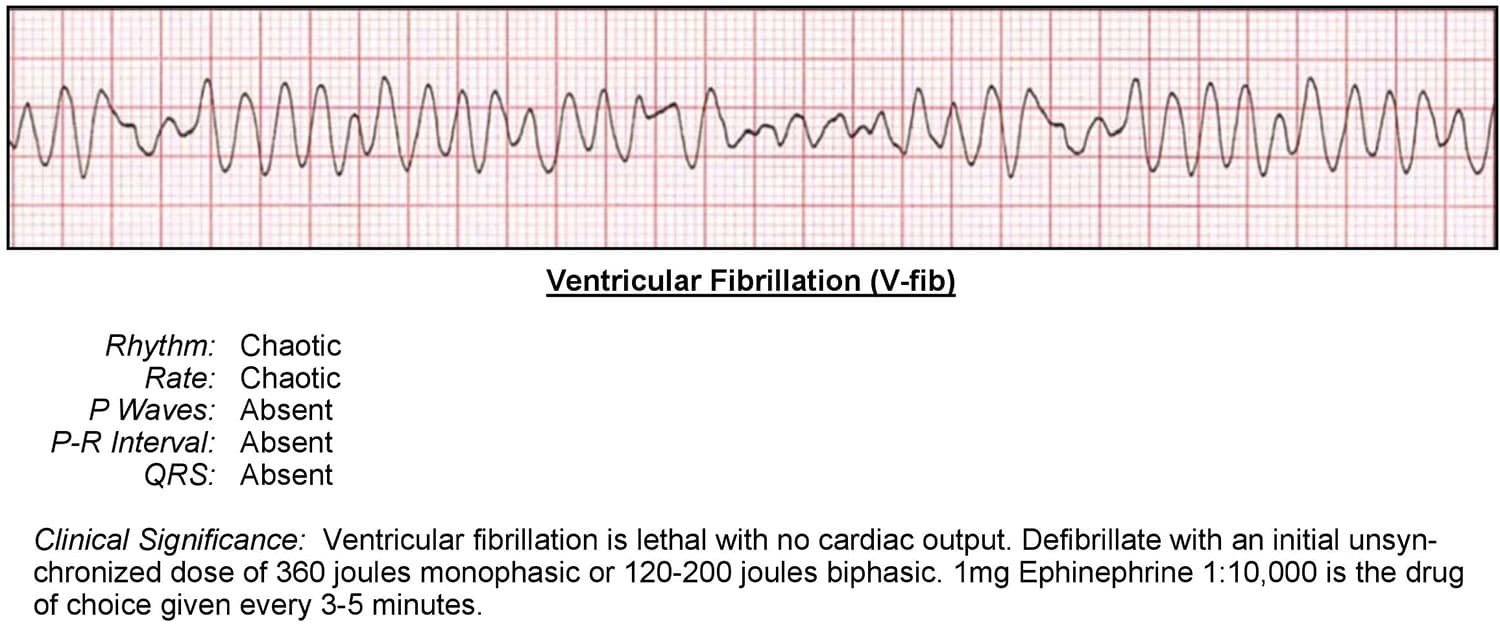 Ventricular Fibrillation ECG