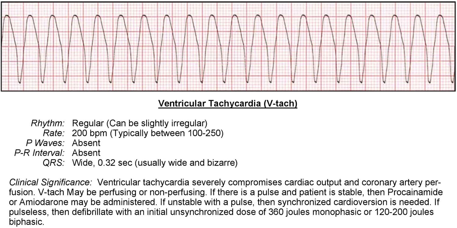 Ventricular Tachycardia Fibrillation Wide Complex Tachycardias | Sexiz Pix